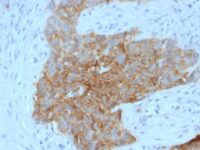 Formalin-fixed, paraffin embedded human tongue sections stained with 100 ul anti-GLUT1 (clone GLUT1/2475) at 1:400. HIER epitope retrieval prior to staining was performed in 10mM Citrate, pH 6.0.